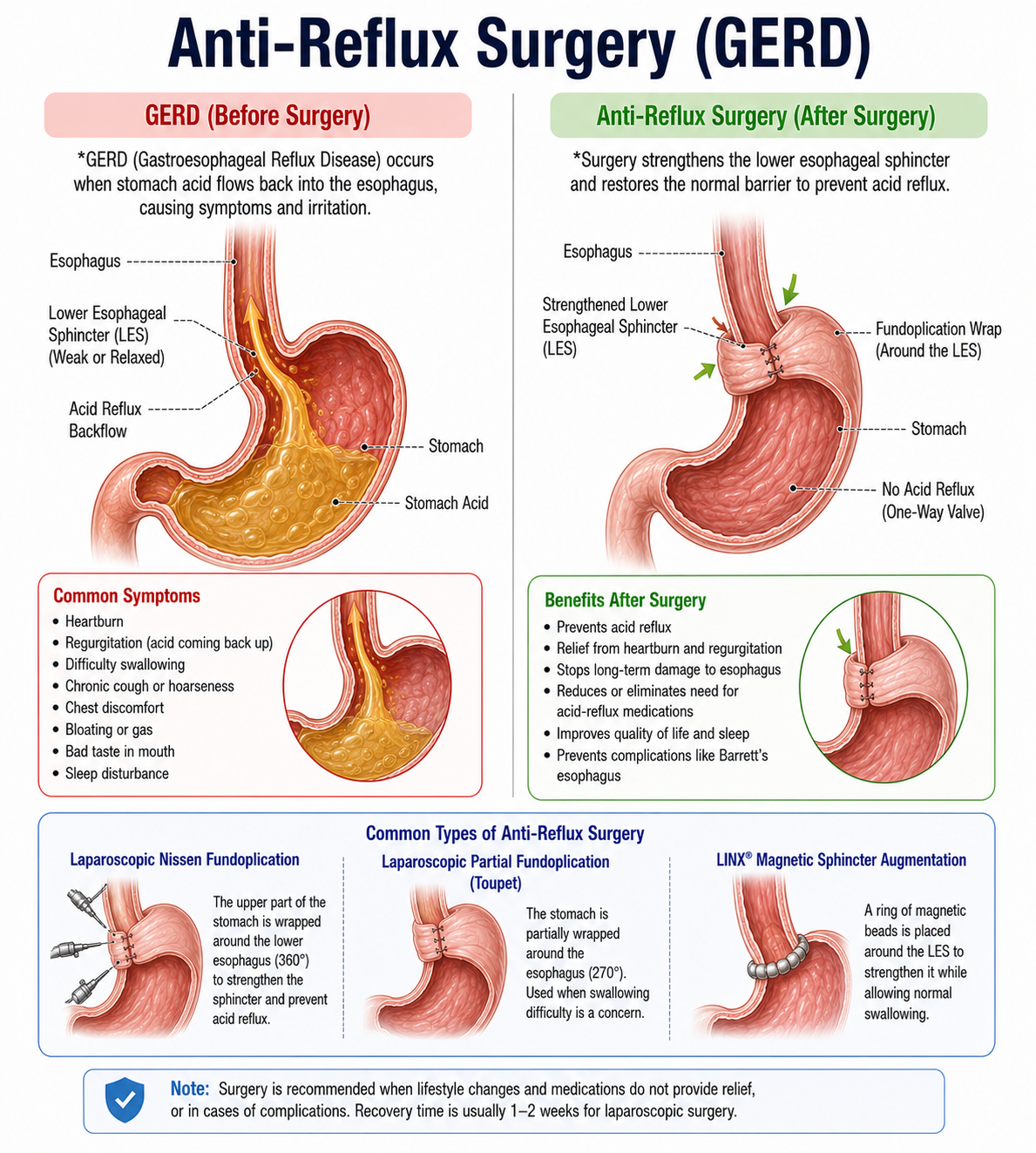 Anti-Reflux Surgery (Laparoscopic Nissen Fundoplication) — anatomy diagram